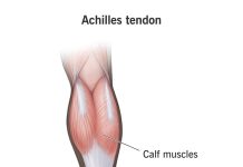 Inflamação do Tendão de Aquiles: O Que Fazer?